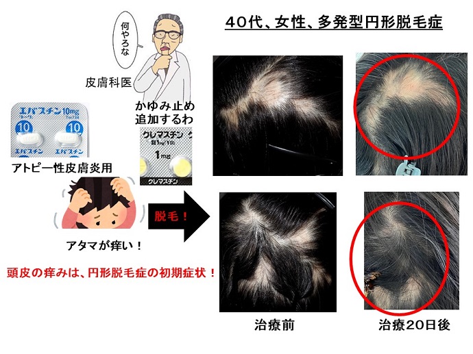 円形脱毛症　病院